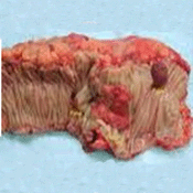 Picture of a cancer of the colon