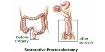Restorative proctocolectomy